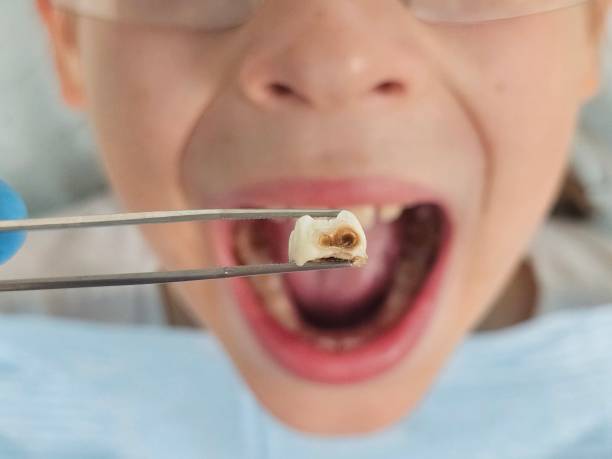 Best Emergency Tooth Extraction in Brush, CO